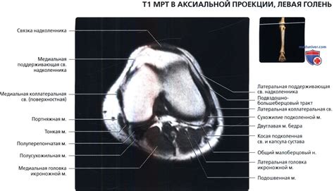 МРТ голени в аксиальной проекции в норме