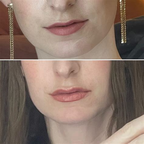 1 mL of lip filler, mostly in upper lip. Really happy with the subtle