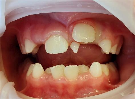 Brisbane Dental Treatment for Extra Teeth Growing in Gums