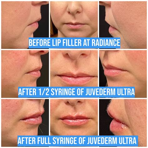 LIP FILLER RESULTS in 2024 | Lip fillers, Lips inspiration, Lips