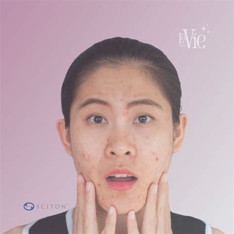 Forever Clear BBL Acne Treatment - La Vie Med Spa