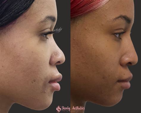 Non-Surgical Rhinoplasty - Before and After Results