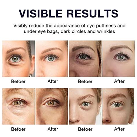 rf radio frequency eye skin tighten  anti aging device  eye