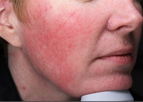 rosacea blood vessel laser treatment physicians laser  dermatology