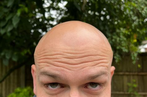 skin tone   bald head skin discoloration