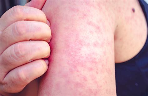 Understanding Measles: Symptoms, Causes, & Treatment