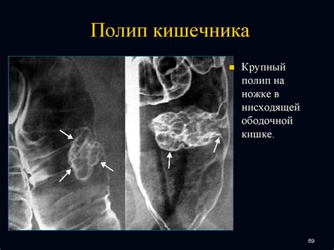 Нормальный пищевод - презентация онлайн