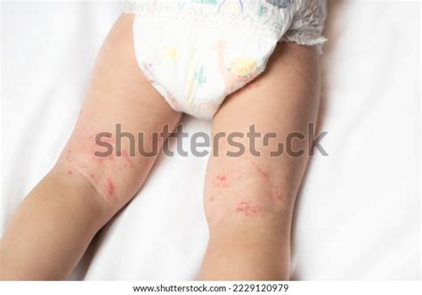 Hand Foot Mouth Disease Rash On Stock Photo 2229120979 | Shutterstock