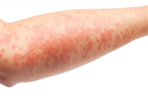 bracos de dermatite atopica