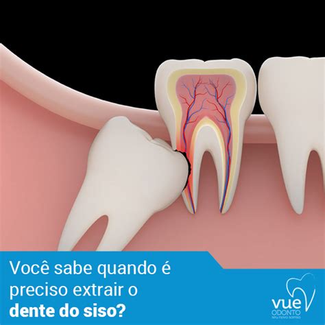 Extrair Dente Do Siso - Você sabe quando é preciso extrair o dente do siso? A necessidade da ...