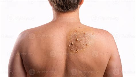 Seborrheic Keratosis Back