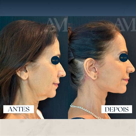Ritidoplastia O Que É - 1- Antes e depois Ritidoplastia - Dr. André Mattos