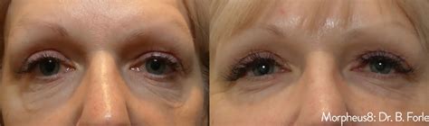 Morpheus8 Brisbane — Collagen Boost in 20 Mins.