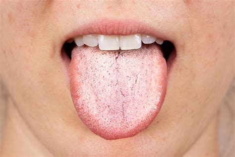 Bumps On Back Of Tongue And Throat