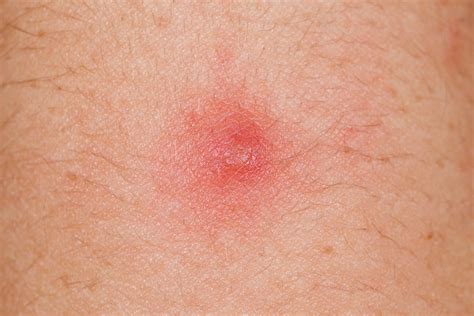 Stages of a boil and when to see a doctor