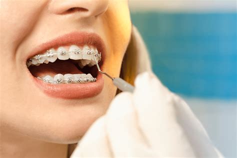 6 Questions to Ask an Orthodontist Before Getting Braces