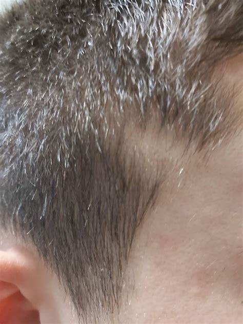 Derma-Docència Castelló: Alopecia triangular temporal