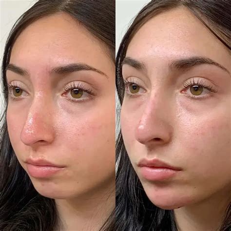 NoseFix: Filler