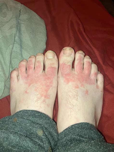 Foot warning, but what is wrong with my feet. They itched for a while
