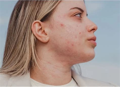 Acne Prone Skin Images | Photo Gallery Of Skin Pictures | The Pink Foundry