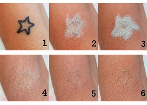 Como Remover Uma Tatuagem - Como Remover Uma Tatuagem : Remoção de tatuagem: como tirar e cuidados ...