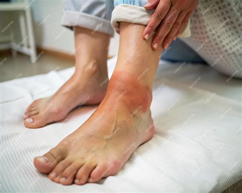 Swollen ankles in females often caused by fluid retention or medical
