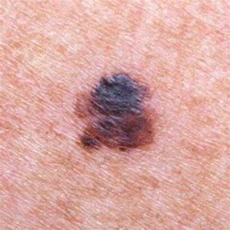 Types Of Melanoma - Melanoma Patients Australia