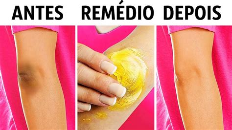 Como Clarear O Joelho - 10 Truques Naturais Para Clarear Os Joelhos e Cotovelos - YouTube