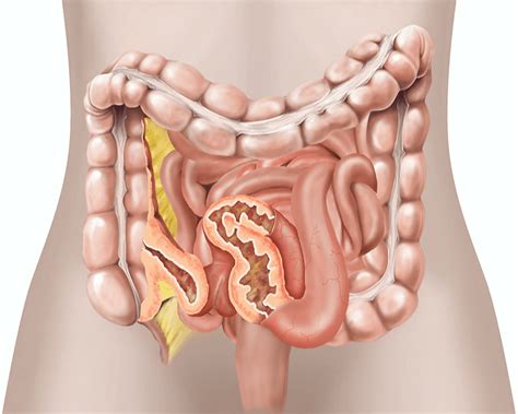 abdominal surgery  crohns disease healthdirect