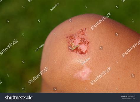 broken knee stock photo  shutterstock
