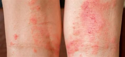 Dermatitis – causes, symptoms, diagnostics. How to cure sweating ...