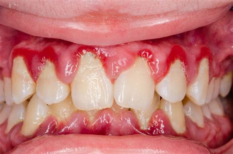 gingivitis  dada foundation