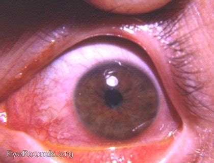 Cornea: corneal abrasion with reflex spastic miosis. EyeRounds.org ...