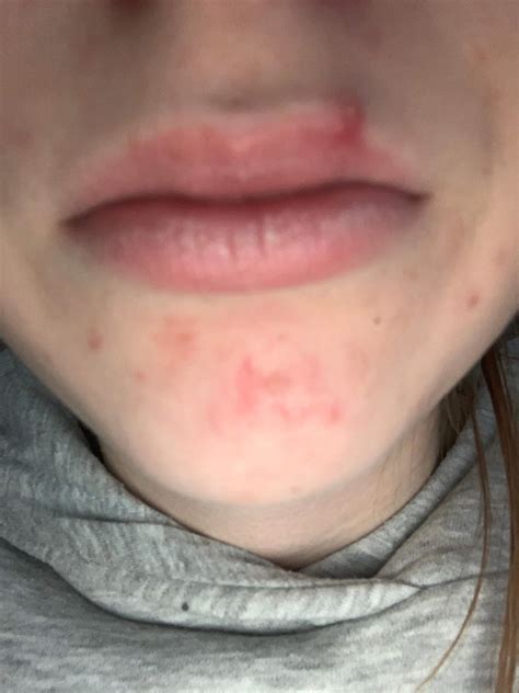 Herpes Austrocknen Oder Feucht Halten 4