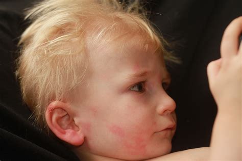 Rash After Walking Outside at Debra Cunningham blog