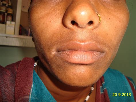 White Spots On Corner Of Lips | Lipstutorial.org