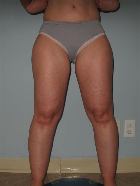 Cellulite Dolorosa ~ Prodotto Speciale Siero Vitamina C