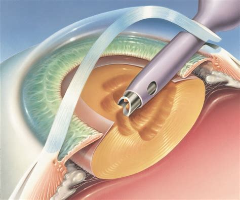 Lens Film After Cataract Surgery at Richard Vasquez blog