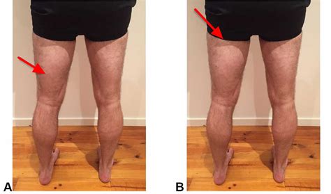 Hamstring Injury - Causes, Symptoms, Recovery Time & Treatment