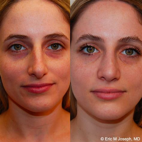 eric  joseph md rhinoplasty