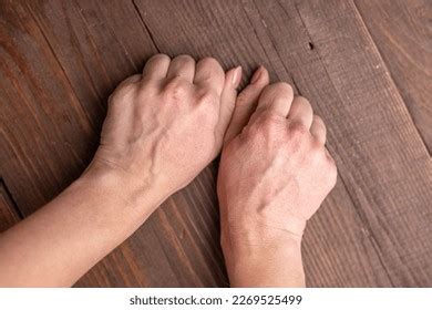 Extremely Dry Dehydrated Cracked Skin Womans Stock Photo 2269525499 | Shutterstock