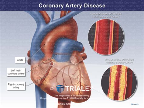coronary artery disease calculator irmt