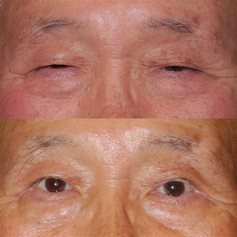 Ptosis Surgery Arlington & Tyson VA