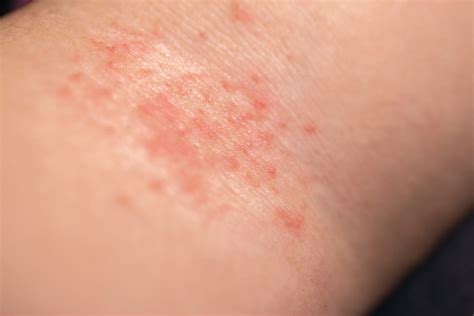Dst Que Da Coceira No Corpo - Coceira no Corpo Todo? Veja as Principais Causas e Soluções | Vuelo Pharma