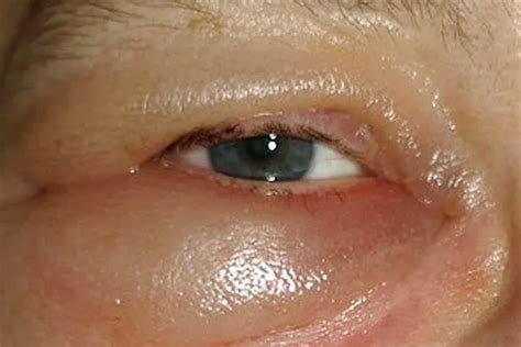 severe eye swelling  zane stirling blog