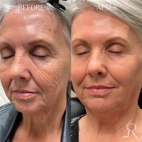 Laser Skin Resurfacing Before & Afters 01
