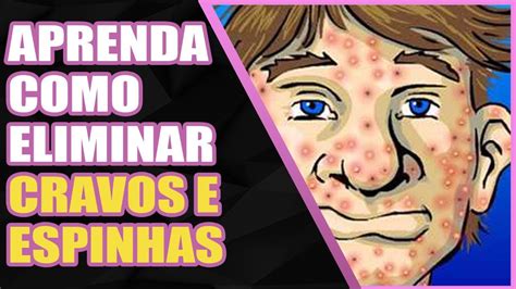 Como Se Formam As Espinhas - Como Se Formam Os Cravos e Espinhas - Saiba Como Elimina-los - YouTube
