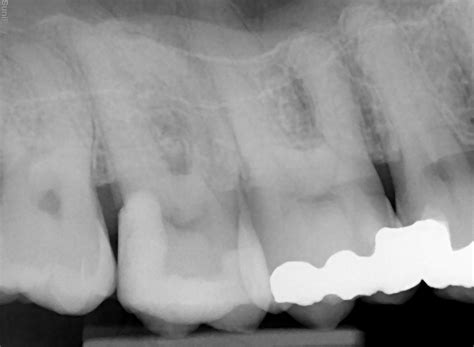 The Dentist - Endodontic complications following restorative treatment