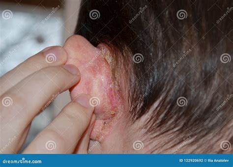 Dermatite Atrás Da Orelha