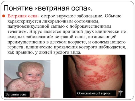 Ветряная оспа презентация, доклад